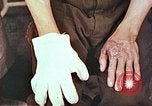 Image of burns on atomic bomb victims Hiroshima Japan, 1946, second 20 stock footage video 65675060688