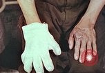 Image of burns on atomic bomb victims Hiroshima Japan, 1946, second 22 stock footage video 65675060688