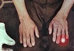 Image of burns on atomic bomb victims Hiroshima Japan, 1946, second 25 stock footage video 65675060688