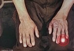 Image of burns on atomic bomb victims Hiroshima Japan, 1946, second 26 stock footage video 65675060688