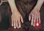 Image of burns on atomic bomb victims Hiroshima Japan, 1946, second 27 stock footage video 65675060688