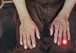 Image of burns on atomic bomb victims Hiroshima Japan, 1946, second 28 stock footage video 65675060688