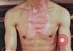 Image of burns on atomic bomb victims Hiroshima Japan, 1946, second 29 stock footage video 65675060688
