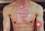 Image of burns on atomic bomb victims Hiroshima Japan, 1946, second 30 stock footage video 65675060688
