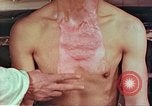 Image of burns on atomic bomb victims Hiroshima Japan, 1946, second 31 stock footage video 65675060688