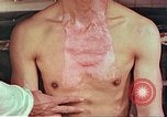 Image of burns on atomic bomb victims Hiroshima Japan, 1946, second 32 stock footage video 65675060688