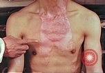 Image of burns on atomic bomb victims Hiroshima Japan, 1946, second 33 stock footage video 65675060688