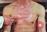Image of burns on atomic bomb victims Hiroshima Japan, 1946, second 34 stock footage video 65675060688