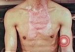 Image of burns on atomic bomb victims Hiroshima Japan, 1946, second 35 stock footage video 65675060688