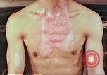 Image of burns on atomic bomb victims Hiroshima Japan, 1946, second 36 stock footage video 65675060688