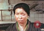 Image facial les blessures d'bombe atomique Hiroshima au Japon, 1946, de la seconde 4 séquences d'archives historiques vidéo 65675060689