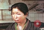 Image facial les blessures d'bombe atomique Hiroshima au Japon, 1946, de la seconde 6 séquences d'archives historiques vidéo 65675060689