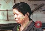 Image facial les blessures d'bombe atomique Hiroshima au Japon, 1946, de la seconde 10 séquences d'archives historiques vidéo 65675060689