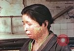 Image facial les blessures d'bombe atomique Hiroshima au Japon, 1946, de la seconde 11 séquences d'archives historiques vidéo 65675060689
