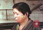 Image facial les blessures d'bombe atomique Hiroshima au Japon, 1946, de la seconde 12 séquences d'archives historiques vidéo 65675060689