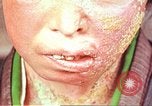 Image facial les blessures d'bombe atomique Hiroshima au Japon, 1946, de la seconde 14 séquences d'archives historiques vidéo 65675060689