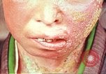 Image facial les blessures d'bombe atomique Hiroshima au Japon, 1946, de la seconde 15 séquences d'archives historiques vidéo 65675060689