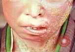 Image facial les blessures d'bombe atomique Hiroshima au Japon, 1946, de la seconde 16 séquences d'archives historiques vidéo 65675060689