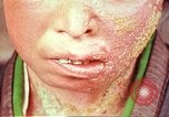Image facial les blessures d'bombe atomique Hiroshima au Japon, 1946, de la seconde 17 séquences d'archives historiques vidéo 65675060689