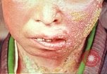 Image facial les blessures d'bombe atomique Hiroshima au Japon, 1946, de la seconde 18 séquences d'archives historiques vidéo 65675060689