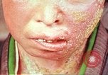 Image facial les blessures d'bombe atomique Hiroshima au Japon, 1946, de la seconde 19 séquences d'archives historiques vidéo 65675060689
