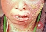 Image facial les blessures d'bombe atomique Hiroshima au Japon, 1946, de la seconde 20 séquences d'archives historiques vidéo 65675060689