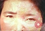 Image facial les blessures d'bombe atomique Hiroshima au Japon, 1946, de la seconde 21 séquences d'archives historiques vidéo 65675060689