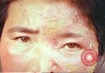 Image facial les blessures d'bombe atomique Hiroshima au Japon, 1946, de la seconde 22 séquences d'archives historiques vidéo 65675060689