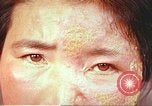 Image facial les blessures d'bombe atomique Hiroshima au Japon, 1946, de la seconde 23 séquences d'archives historiques vidéo 65675060689