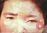 Image facial les blessures d'bombe atomique Hiroshima au Japon, 1946, de la seconde 24 séquences d'archives historiques vidéo 65675060689