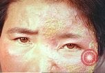 Image facial les blessures d'bombe atomique Hiroshima au Japon, 1946, de la seconde 25 séquences d'archives historiques vidéo 65675060689