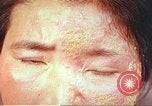 Image facial les blessures d'bombe atomique Hiroshima au Japon, 1946, de la seconde 26 séquences d'archives historiques vidéo 65675060689