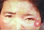 Image facial les blessures d'bombe atomique Hiroshima au Japon, 1946, de la seconde 27 séquences d'archives historiques vidéo 65675060689