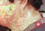 Image facial les blessures d'bombe atomique Hiroshima au Japon, 1946, de la seconde 28 séquences d'archives historiques vidéo 65675060689