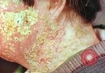 Image facial les blessures d'bombe atomique Hiroshima au Japon, 1946, de la seconde 29 séquences d'archives historiques vidéo 65675060689