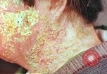 Image facial les blessures d'bombe atomique Hiroshima au Japon, 1946, de la seconde 30 séquences d'archives historiques vidéo 65675060689