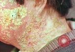 Image facial les blessures d'bombe atomique Hiroshima au Japon, 1946, de la seconde 31 séquences d'archives historiques vidéo 65675060689