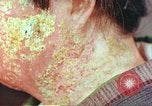 Image facial les blessures d'bombe atomique Hiroshima au Japon, 1946, de la seconde 32 séquences d'archives historiques vidéo 65675060689