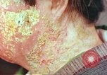 Image facial les blessures d'bombe atomique Hiroshima au Japon, 1946, de la seconde 33 séquences d'archives historiques vidéo 65675060689