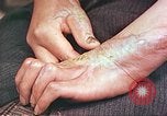 Image of medical care for atomic bomb victim Hiroshima Japan, 1946, second 5 stock footage video 65675060690