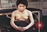 Image of medical care for atomic bomb victim Hiroshima Japan, 1946, second 11 stock footage video 65675060690