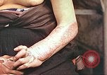 Image of medical care for atomic bomb victim Hiroshima Japan, 1946, second 13 stock footage video 65675060690
