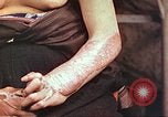 Image of medical care for atomic bomb victim Hiroshima Japan, 1946, second 16 stock footage video 65675060690