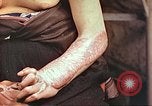 Image of medical care for atomic bomb victim Hiroshima Japan, 1946, second 17 stock footage video 65675060690