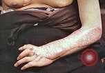 Image of medical care for atomic bomb victim Hiroshima Japan, 1946, second 19 stock footage video 65675060690
