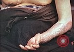 Image of medical care for atomic bomb victim Hiroshima Japan, 1946, second 20 stock footage video 65675060690