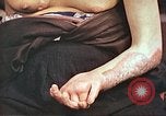 Image of medical care for atomic bomb victim Hiroshima Japan, 1946, second 21 stock footage video 65675060690