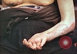 Image of medical care for atomic bomb victim Hiroshima Japan, 1946, second 22 stock footage video 65675060690