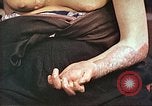 Image of medical care for atomic bomb victim Hiroshima Japan, 1946, second 24 stock footage video 65675060690