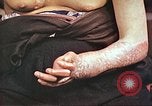 Image of medical care for atomic bomb victim Hiroshima Japan, 1946, second 25 stock footage video 65675060690